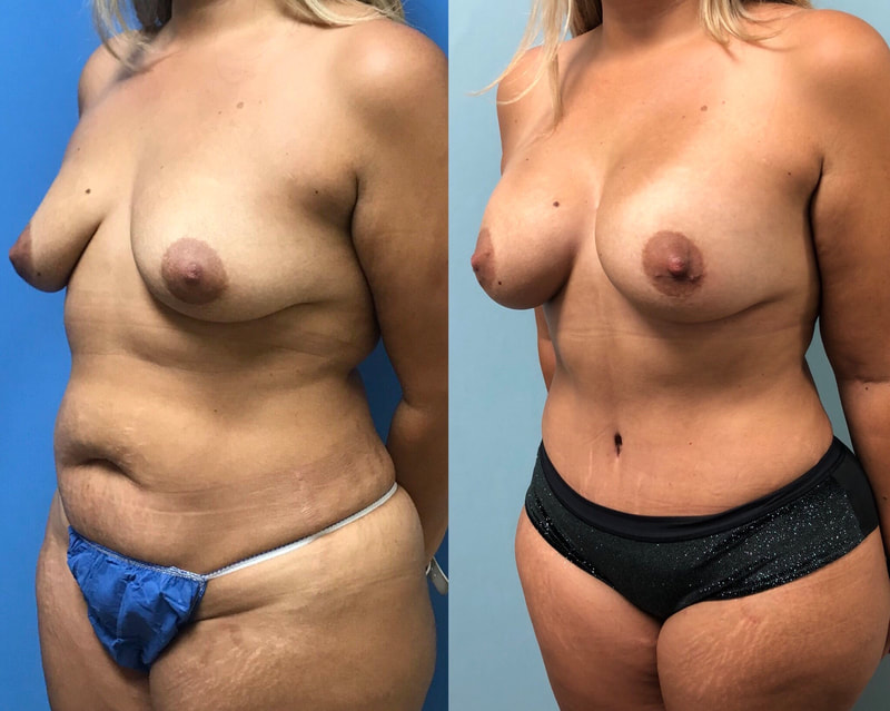 tummy tuck  - before & after 60