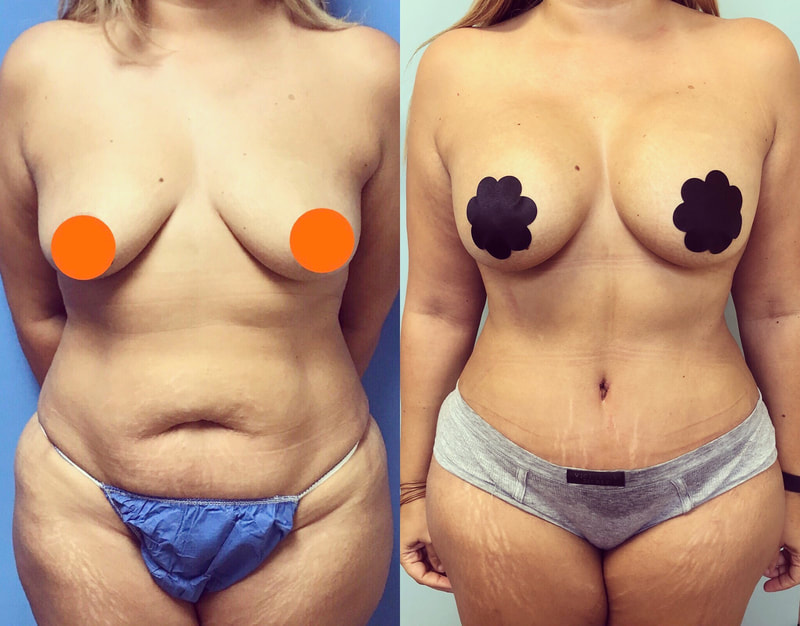 tummy tuck  - before & after 61
