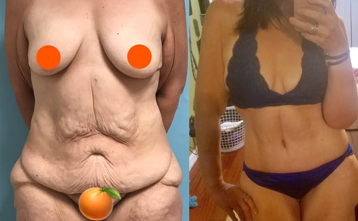 tummy tuck  - before & after 62