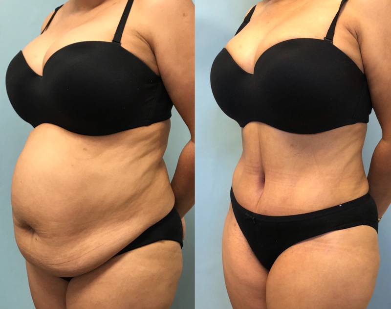 tummy tuck  - before & after 63