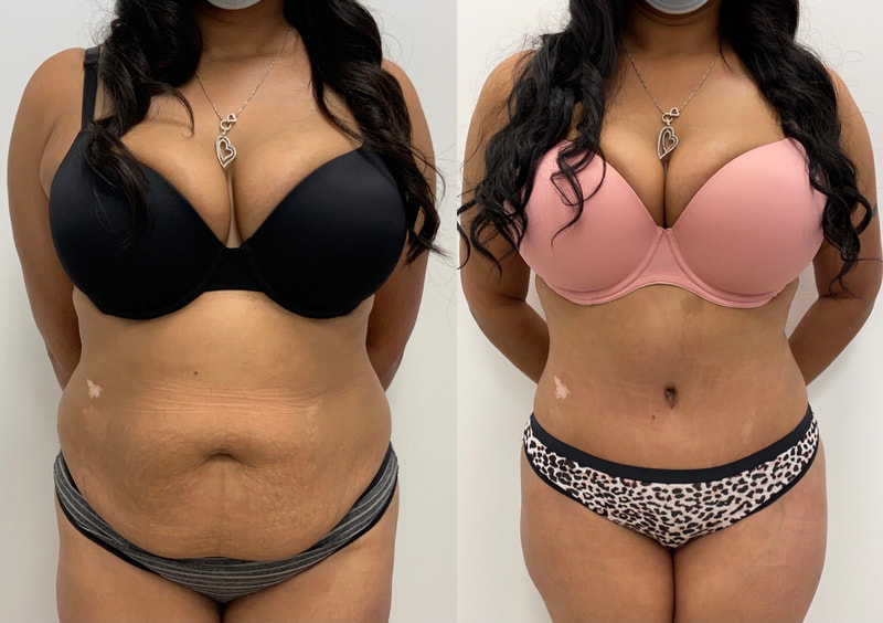 tummy tuck  - before & after 131