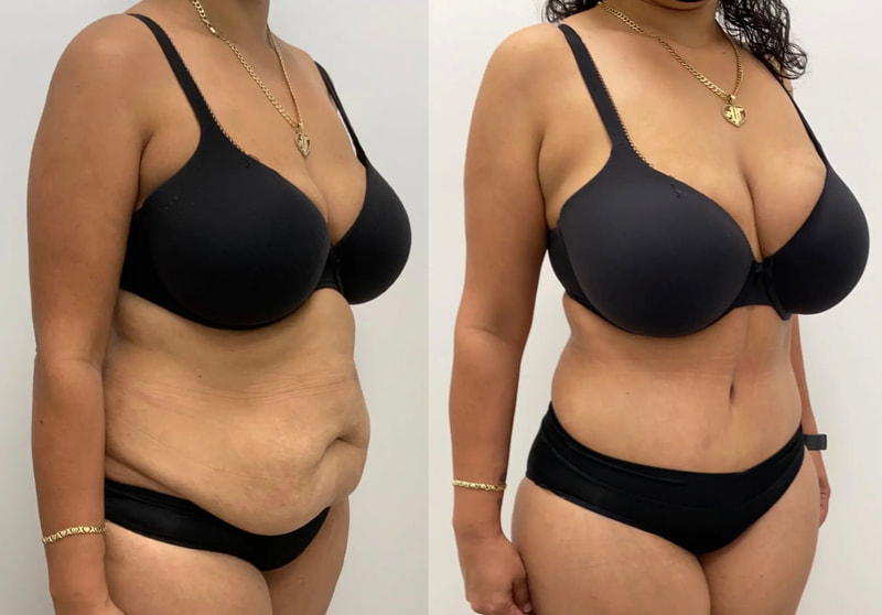 tummy tuck  - before & after 125