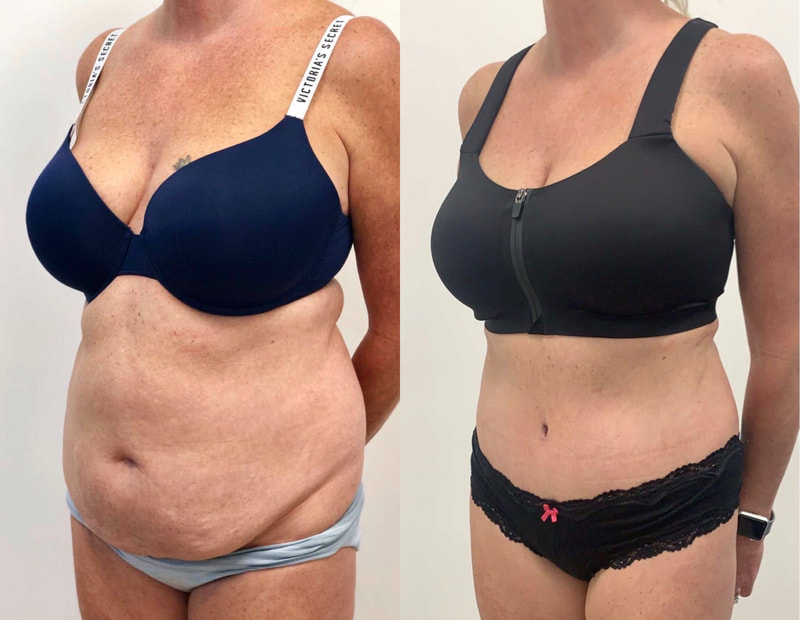 tummy tuck  - before & after 64