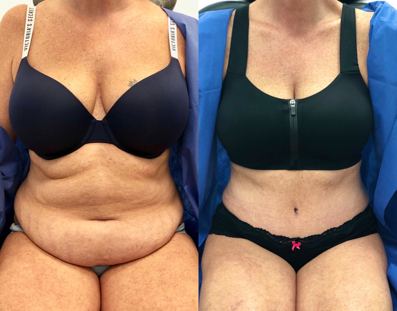 tummy tuck  - before & after 65