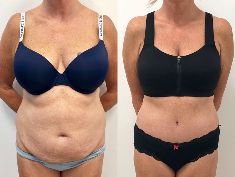 tummy tuck  - before & after 66