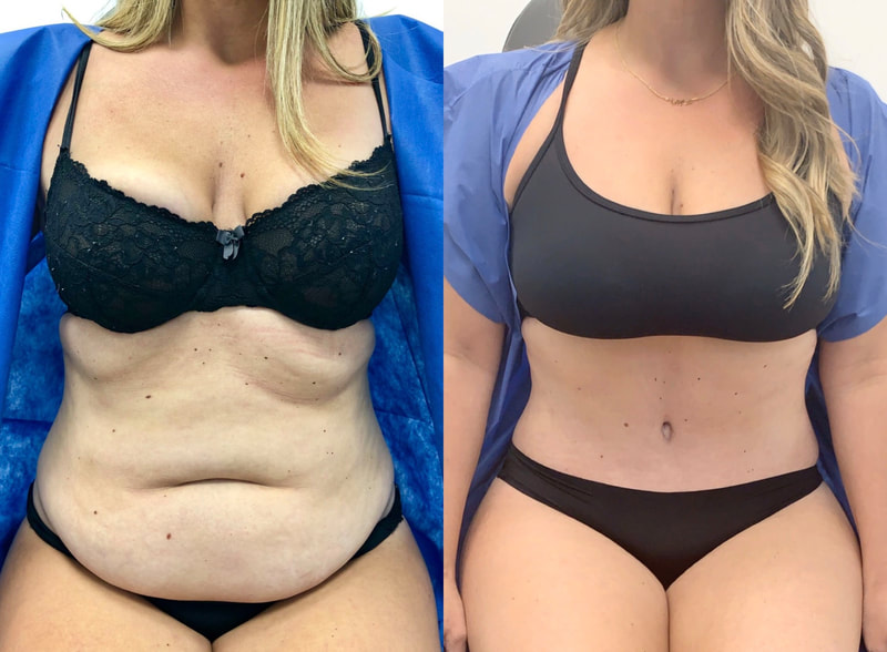 tummy tuck  - before & after 67