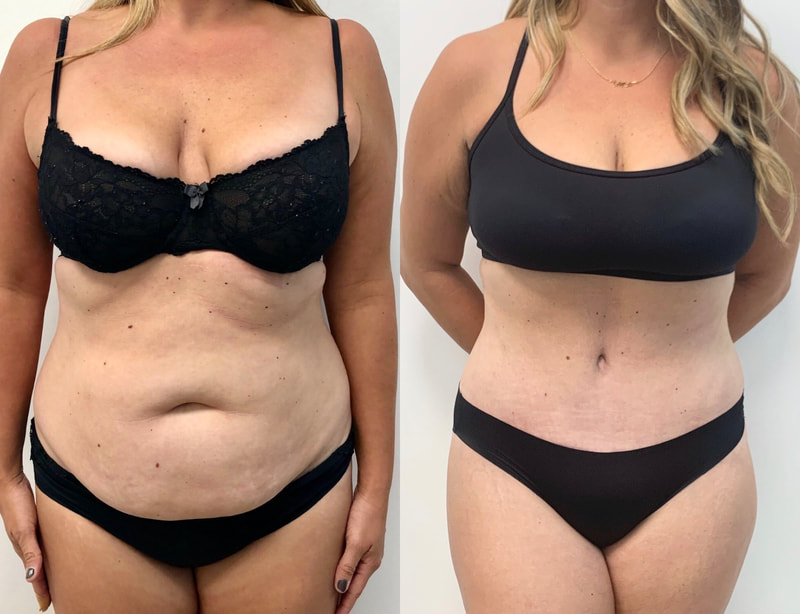 tummy tuck  - before & after 68
