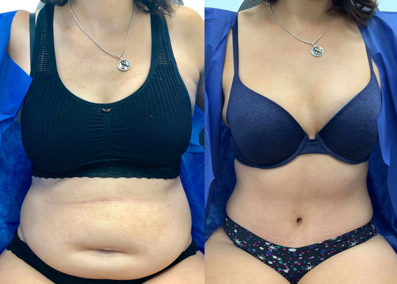 tummy tuck  - before & after 71