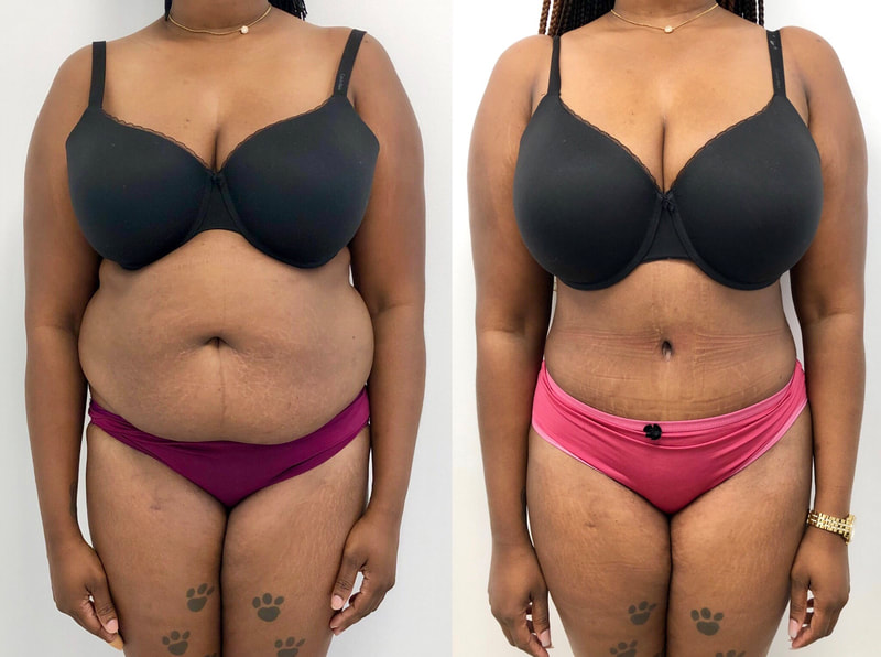 tummy tuck  - before & after 72