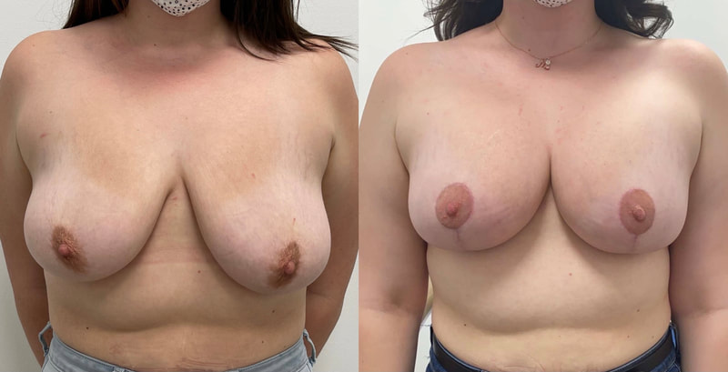 Breast implant before & after 125