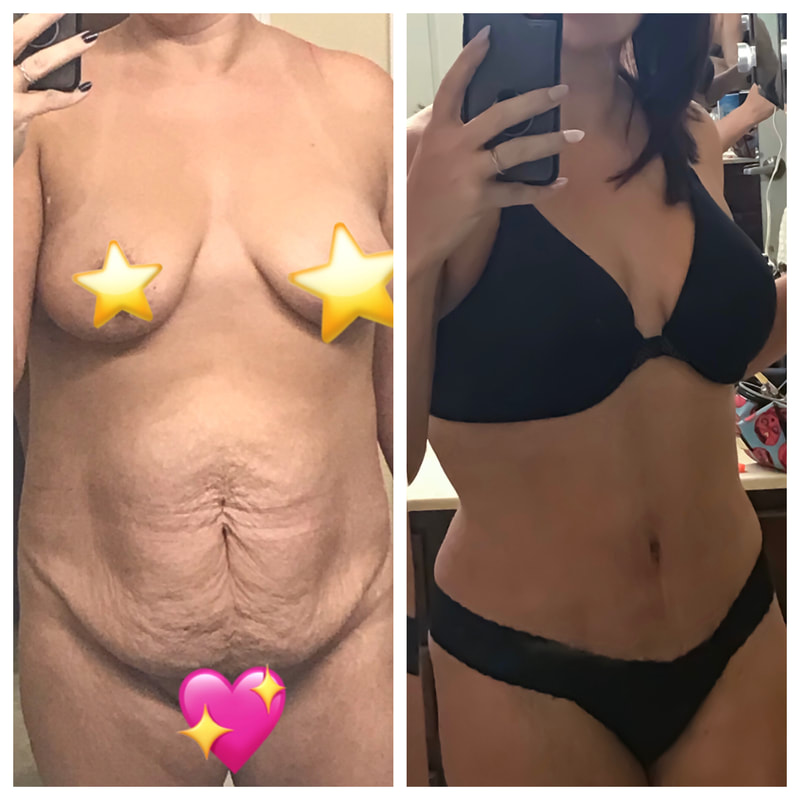 tummy tuck  - before & after 74