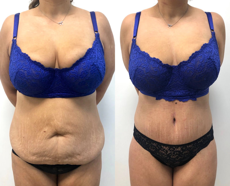 tummy tuck  - before & after 75