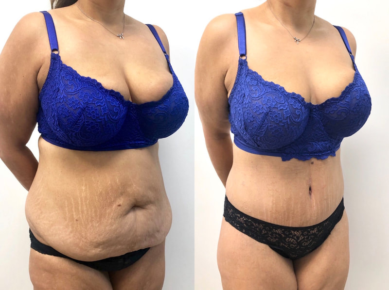tummy tuck  - before & after 76