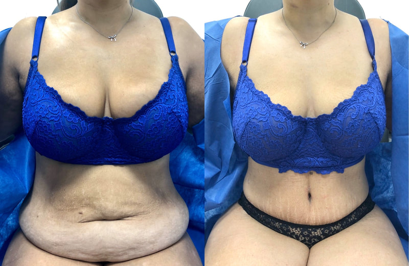 tummy tuck  - before & after 77