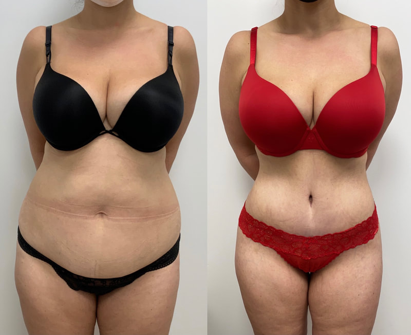 tummy tuck  - before & after 133