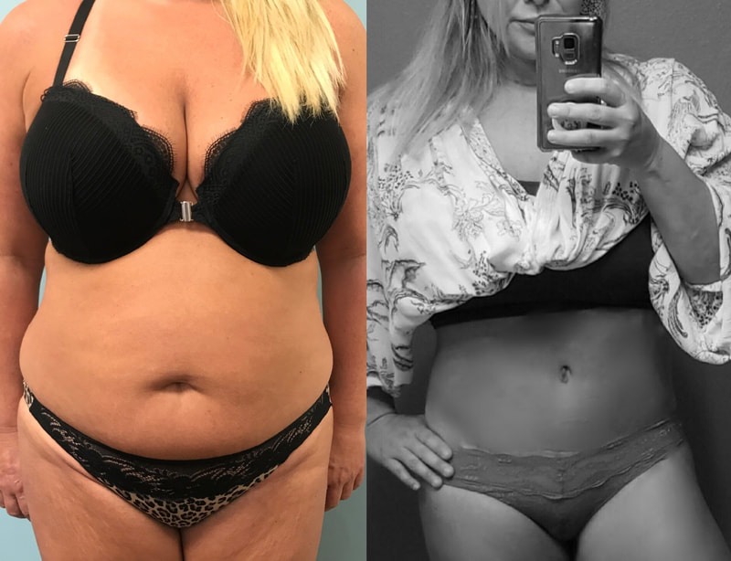 tummy tuck  - before & after 78