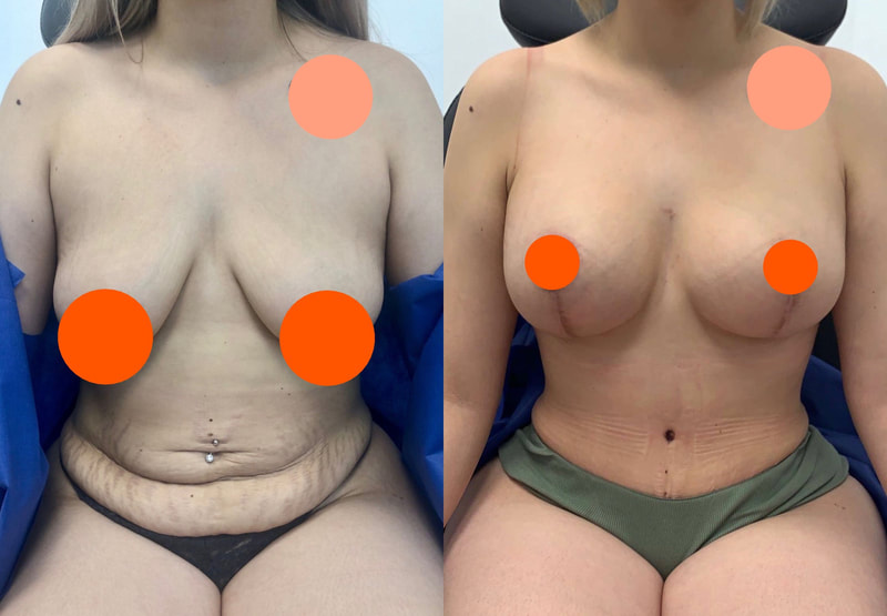 tummy tuck  - before & after 79