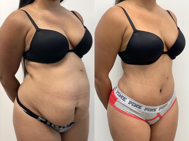 tummy tuck  - before & after 9