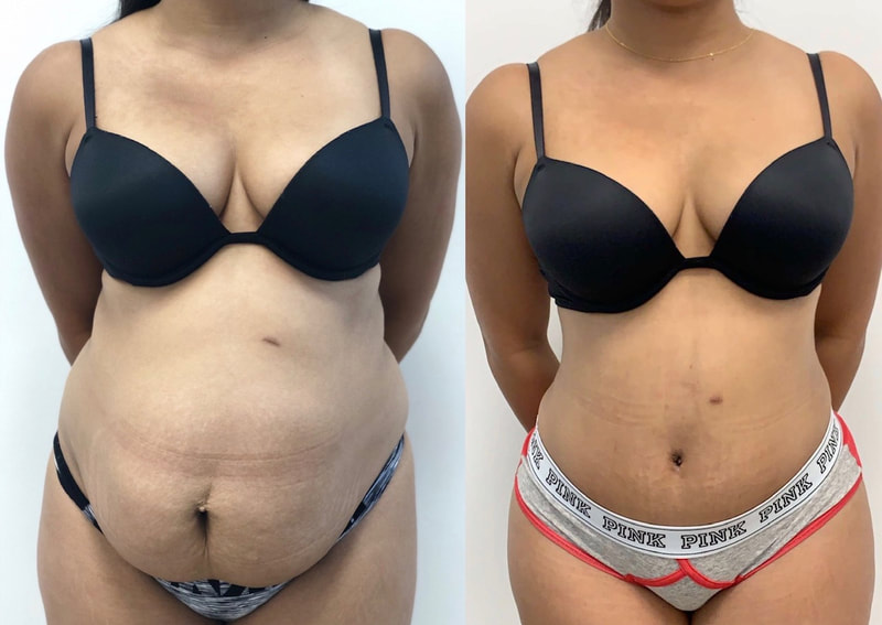 tummy tuck  - before & after 10