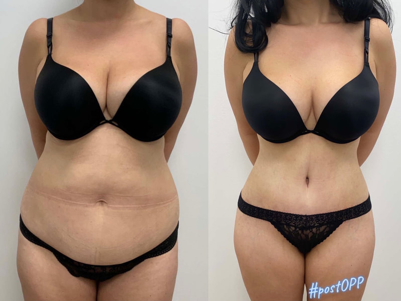 tummy tuck  - before & after 127