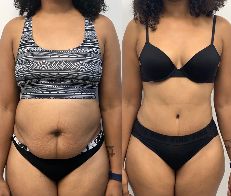 tummy tuck  - before & after 80