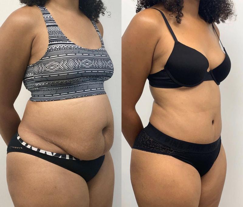tummy tuck  - before & after 81