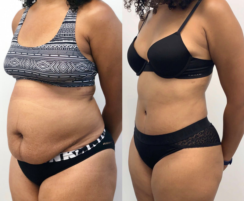 tummy tuck  - before & after 82