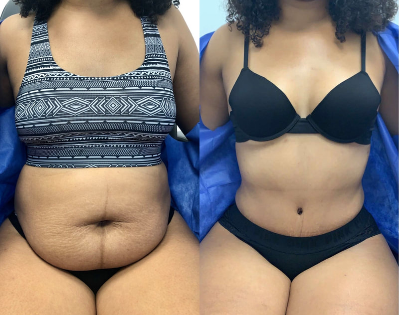 tummy tuck  - before & after 83