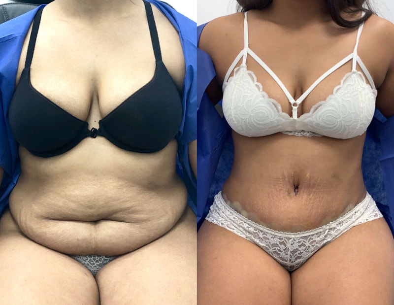 tummy tuck  - before & after 84