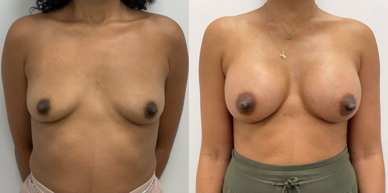 Breast implant before & after 122