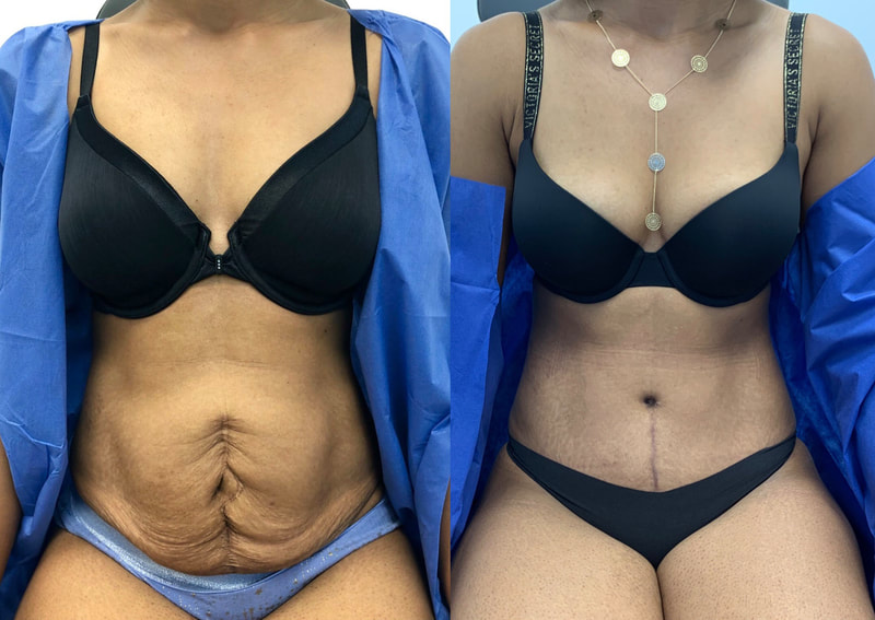 tummy tuck  - before & after 85