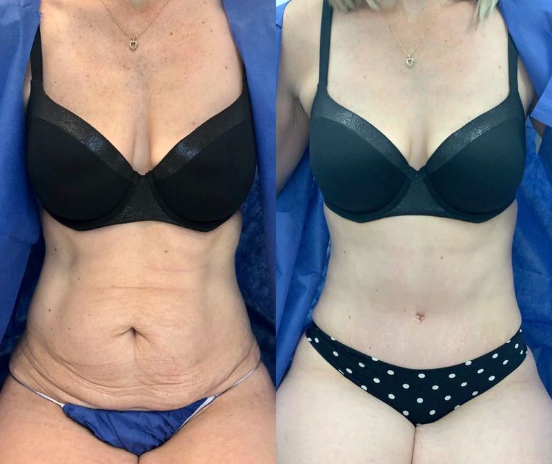 tummy tuck  - before & after 86