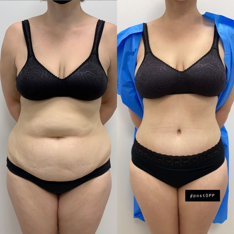 tummy tuck  - before & after 122