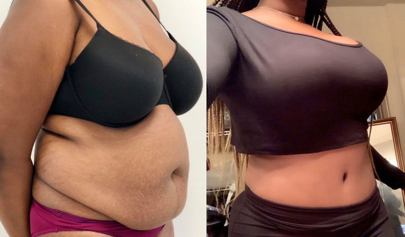 tummy tuck  - before & after 87