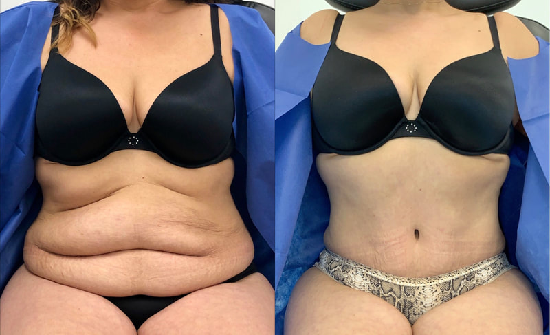 tummy tuck  - before & after 88