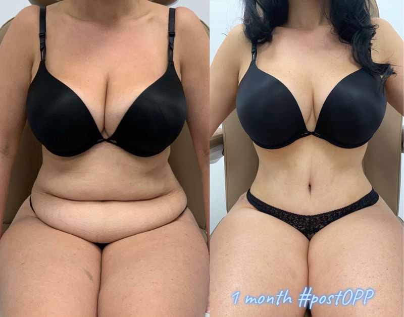 tummy tuck  - before & after 126