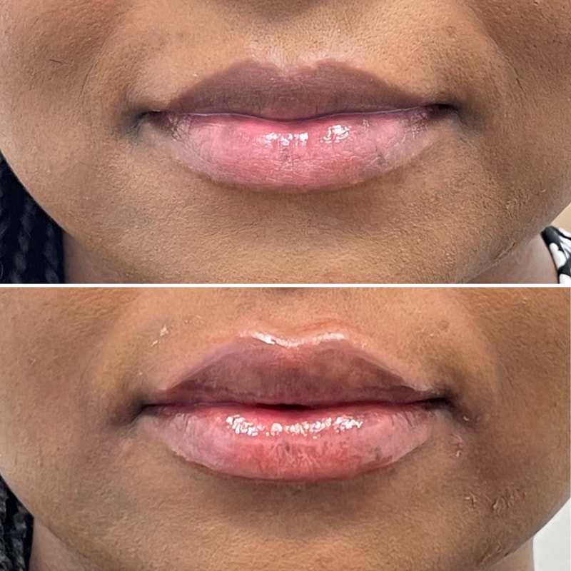 Lip Injection - Before & After 17