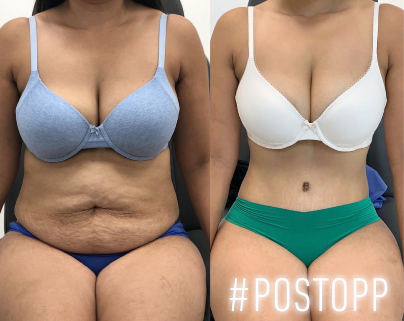 tummy tuck  - before & after 12