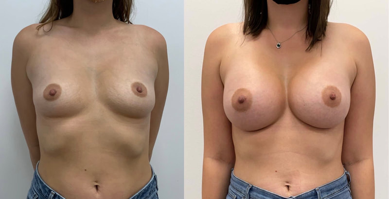 Breast implant before & after 121