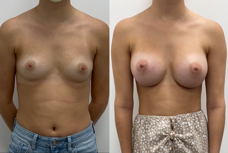 Breast implant before & after 115