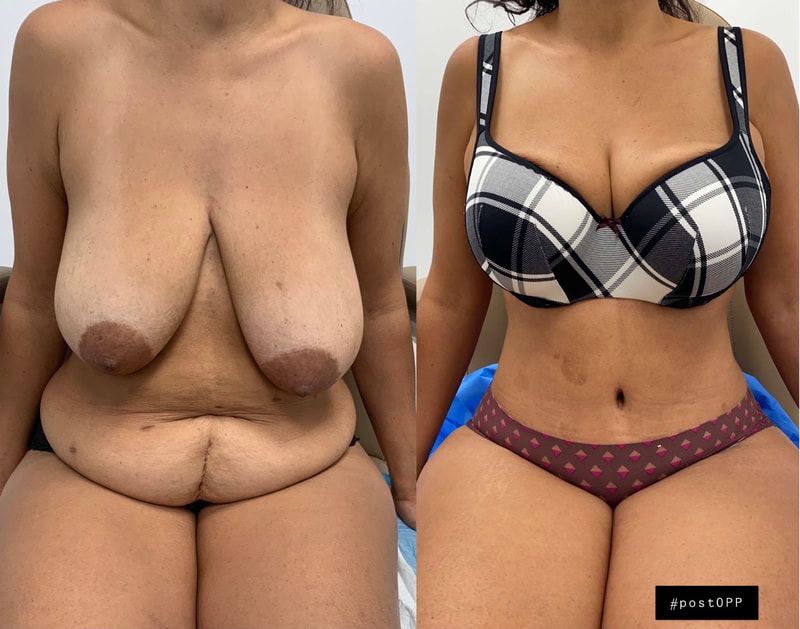 tummy tuck  - before & after 141
