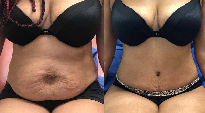tummy tuck  - before & after 13