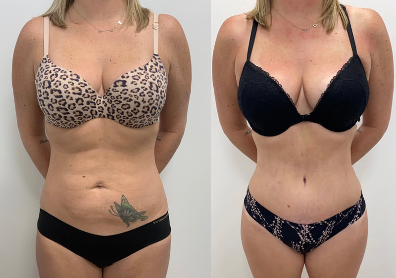 tummy tuck  - before & after 147