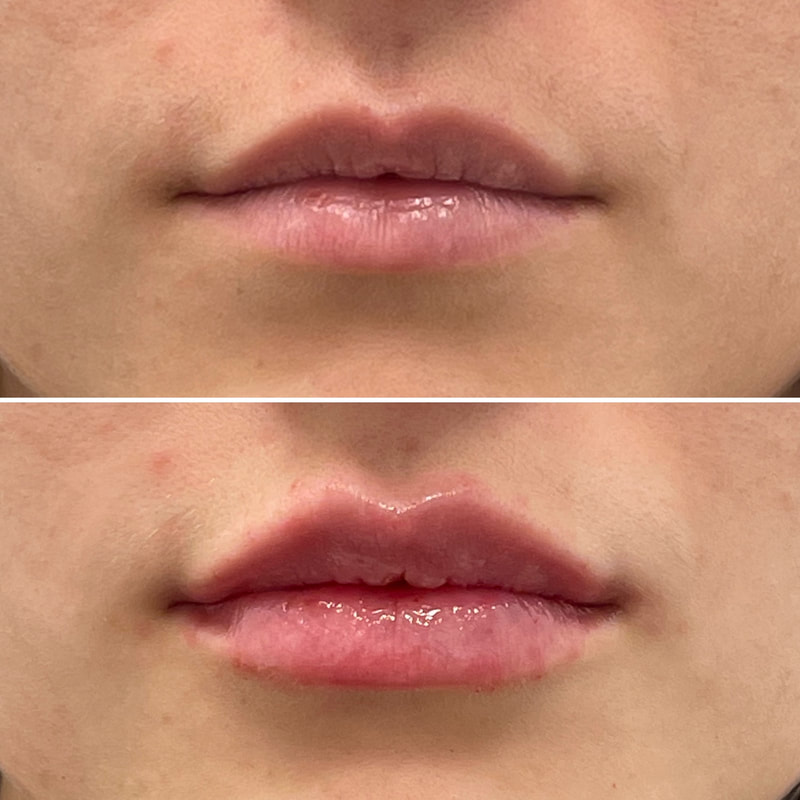 Lip Injection - Before & After 16