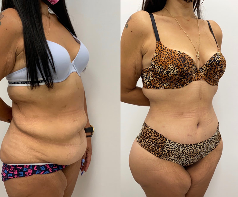 tummy tuck  - before & after 117