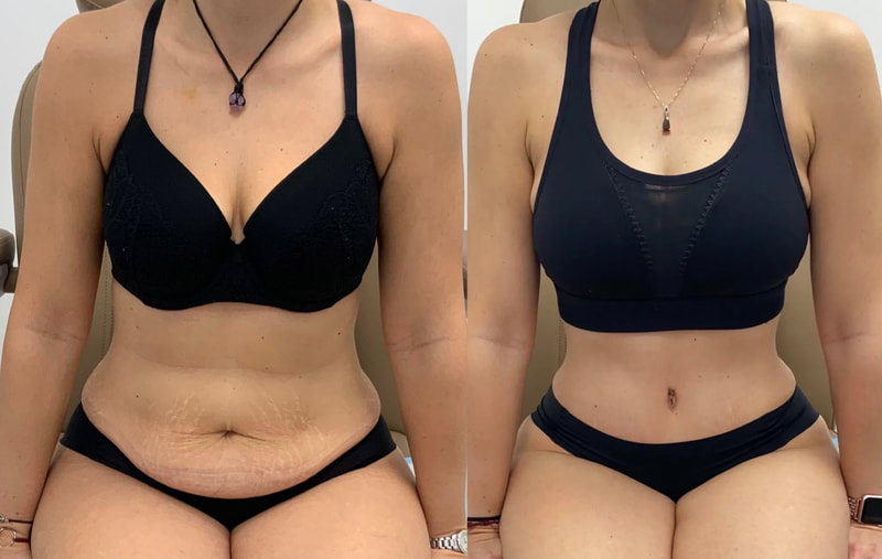 tummy tuck  - before & after 137