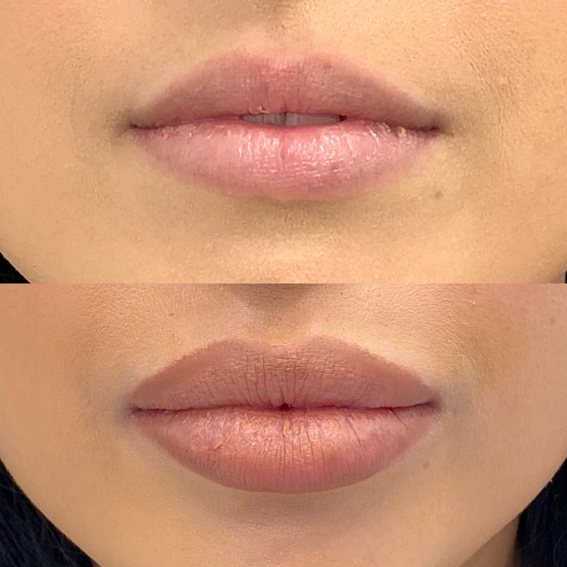 Lip Injection - Before & After 1