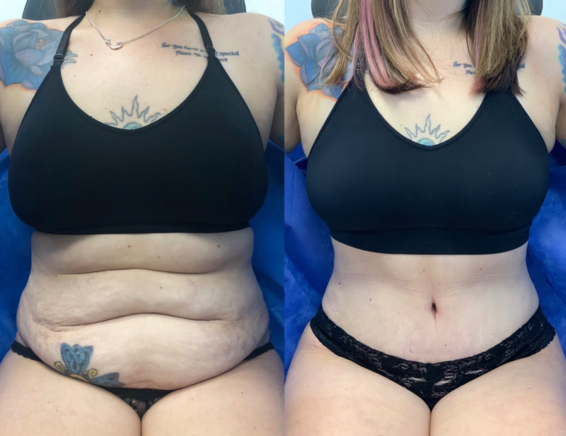 tummy tuck  - before & after 14
