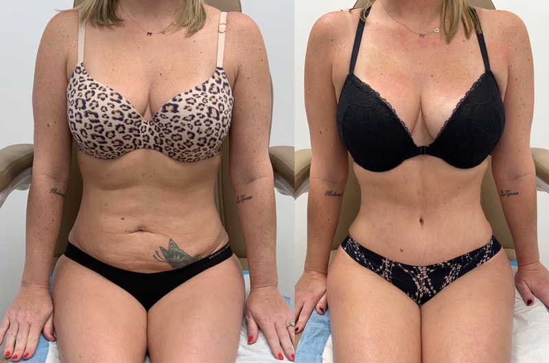 tummy tuck  - before & after 146