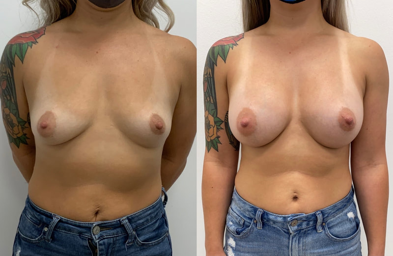 Breast implant before & after 126